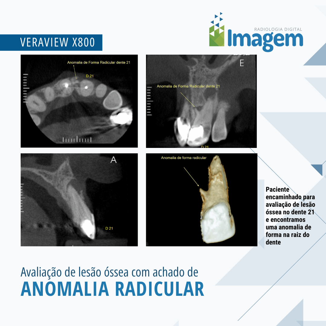 Imagens de exames tomográficos mostrando anomalia radicular