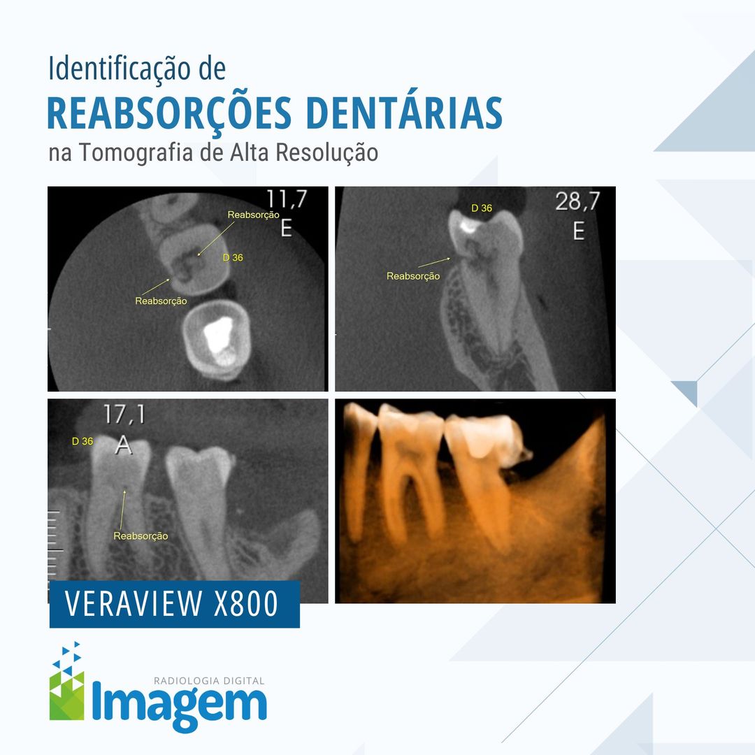 identificacao-de-reabsorcoes-dentarias-na-tomografia-de-alta-resolucao