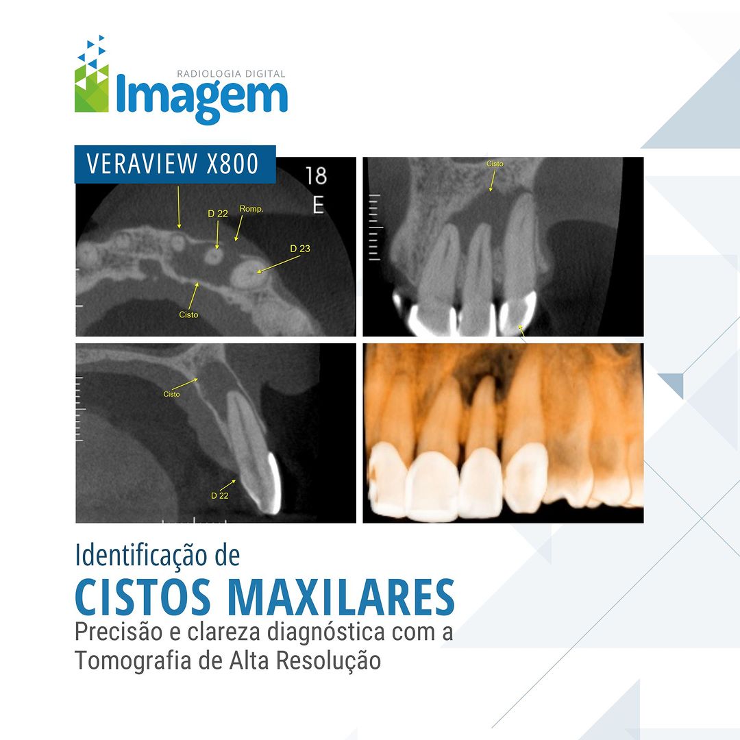identificacao-de-cistos-maxilares