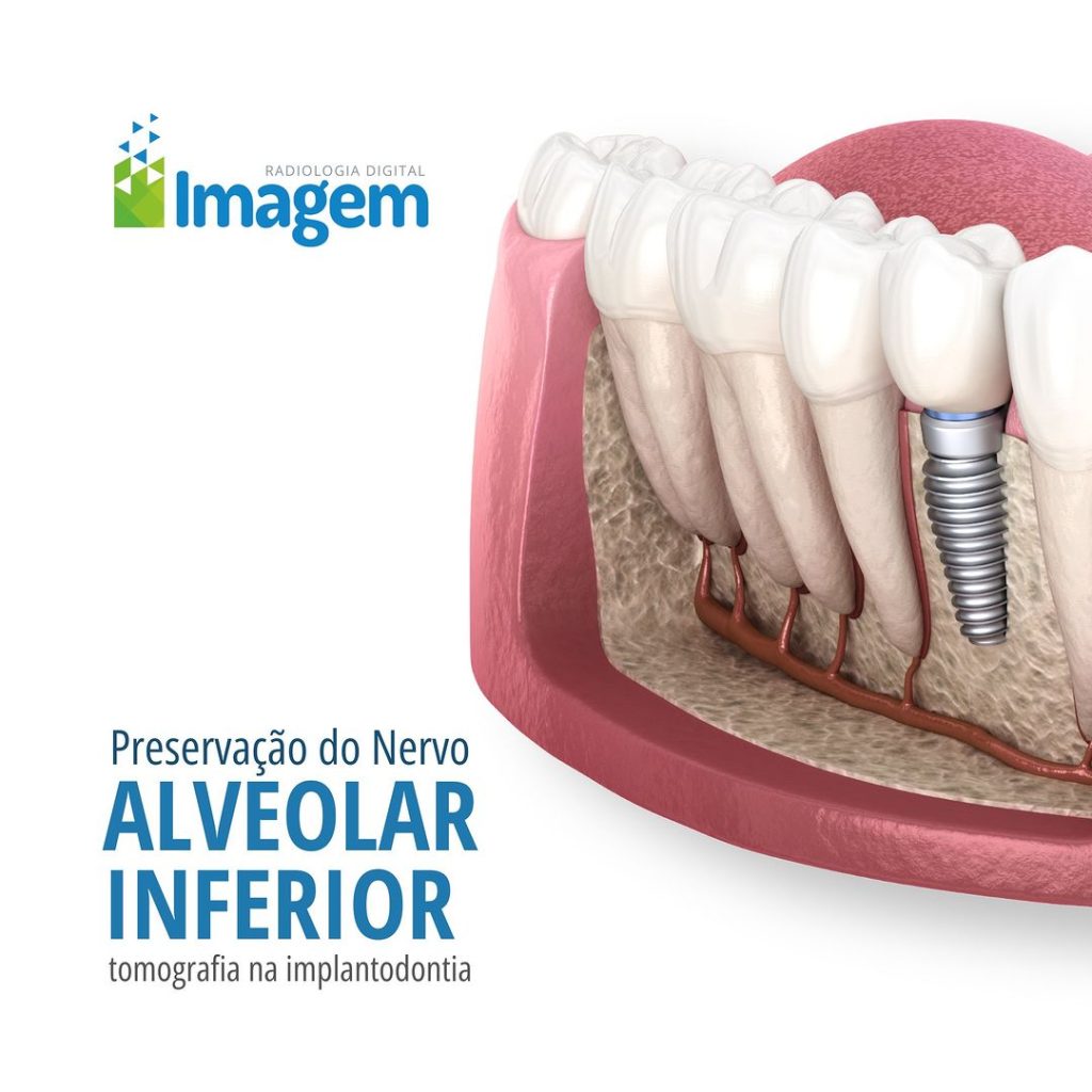 preservacao-do-nervo-alveolar-inferior