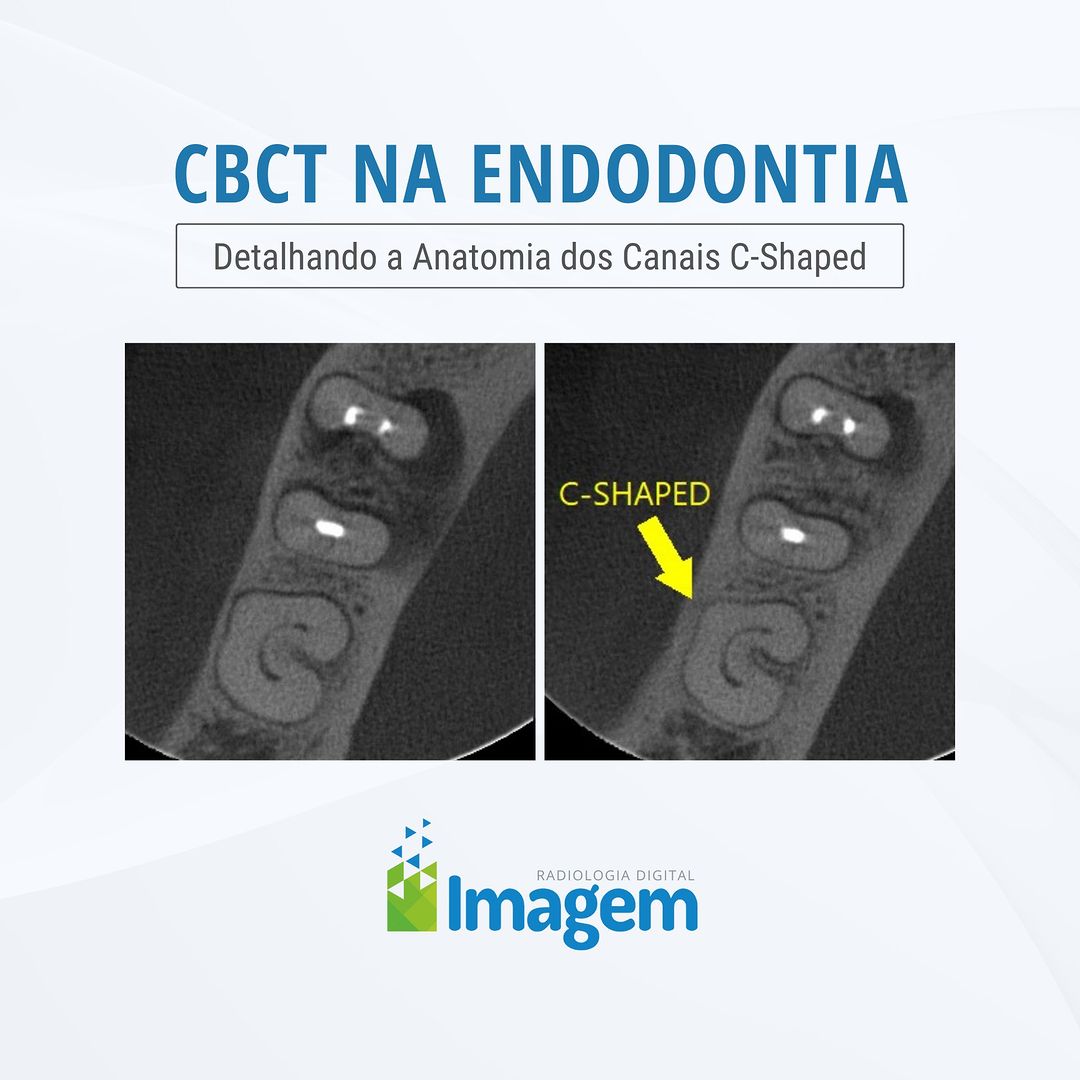 cbct-na-endodontia