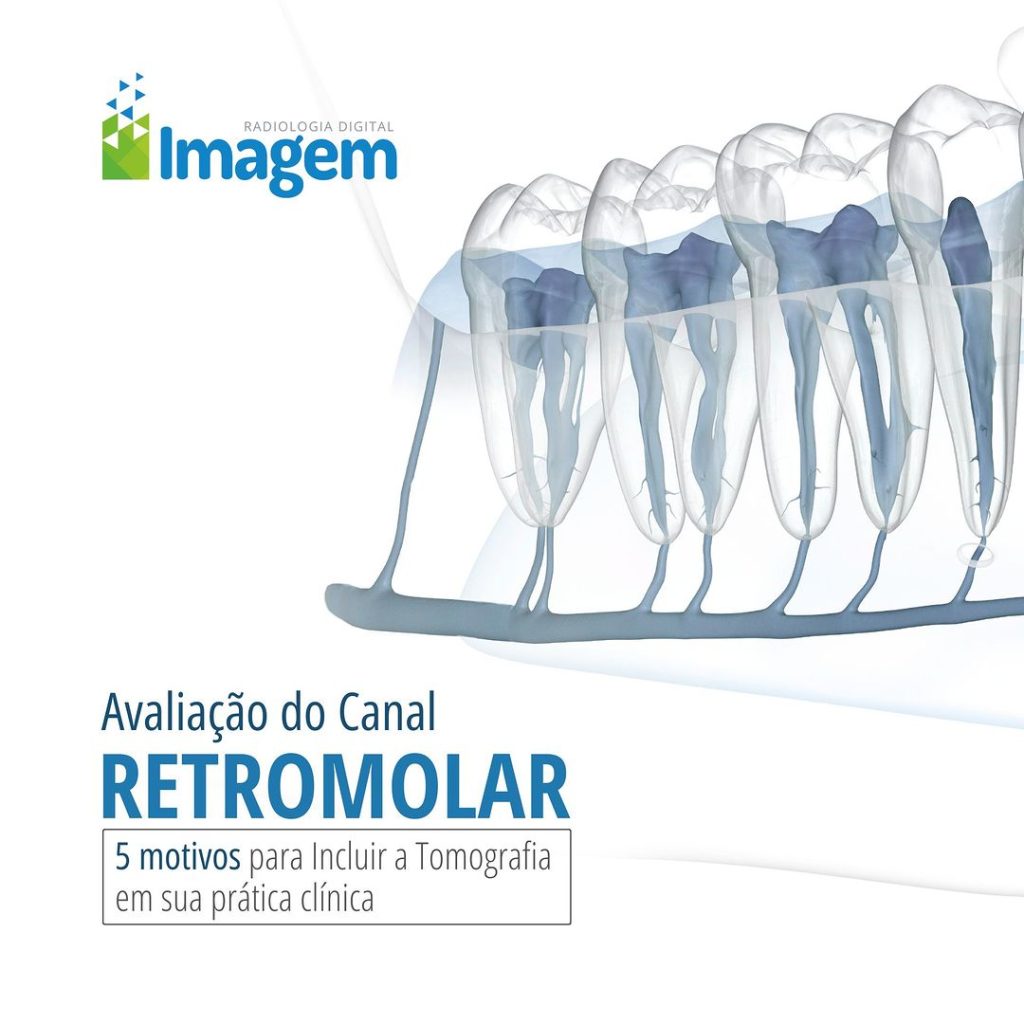 avaliacao-do-canal-retromolar