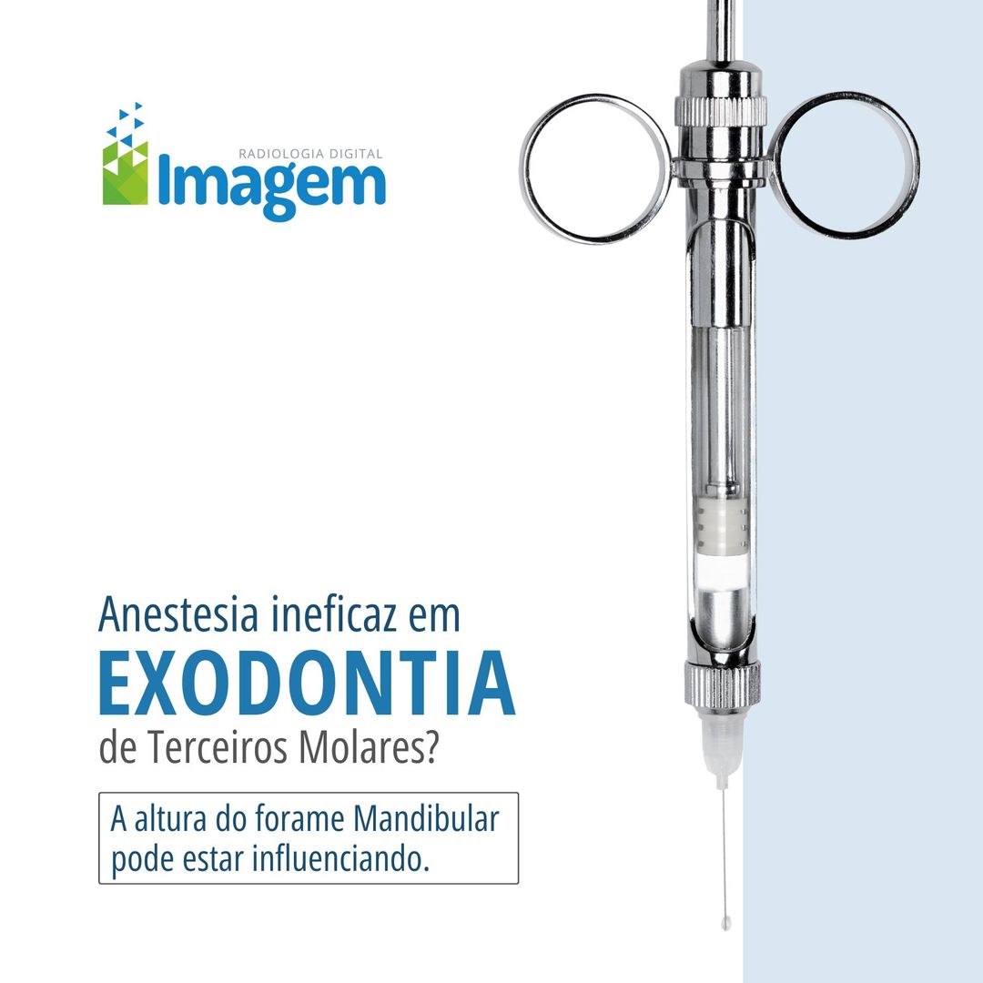 anestesia-ineficaz-em-exodontia