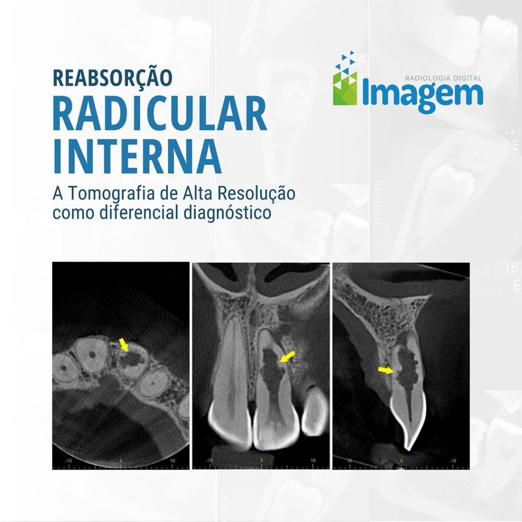 reabsorcao-radicular-interna