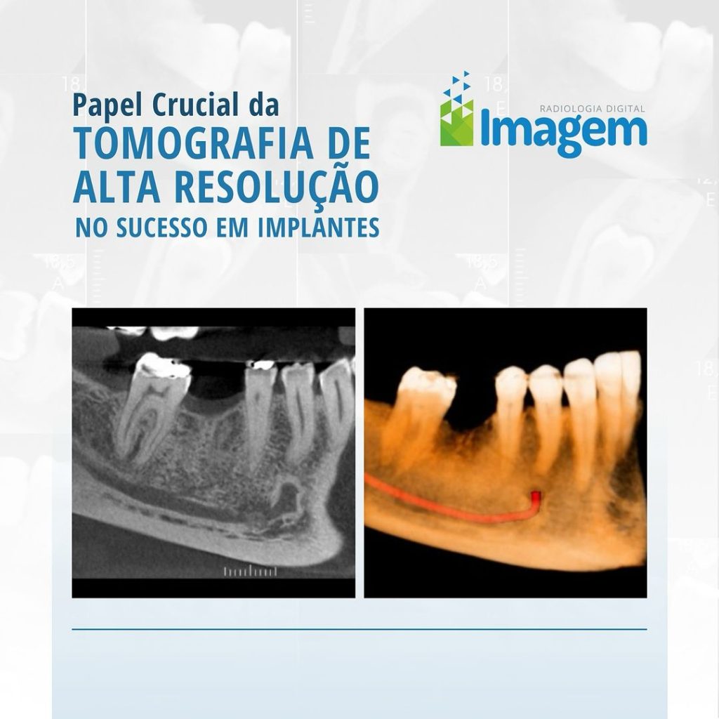 papel-crucial-da-tomografia-de-alta-resolucao-no-sucesso-em-implantes